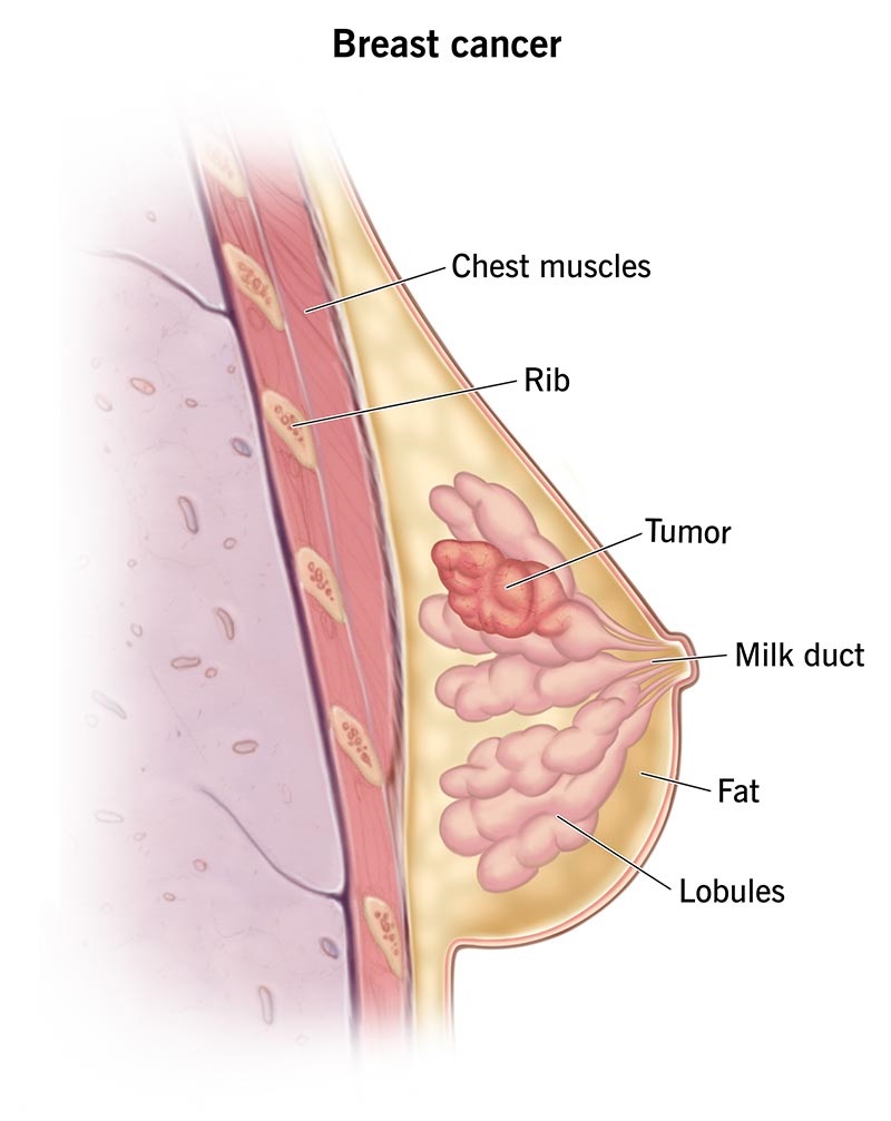 causes of breast cancer