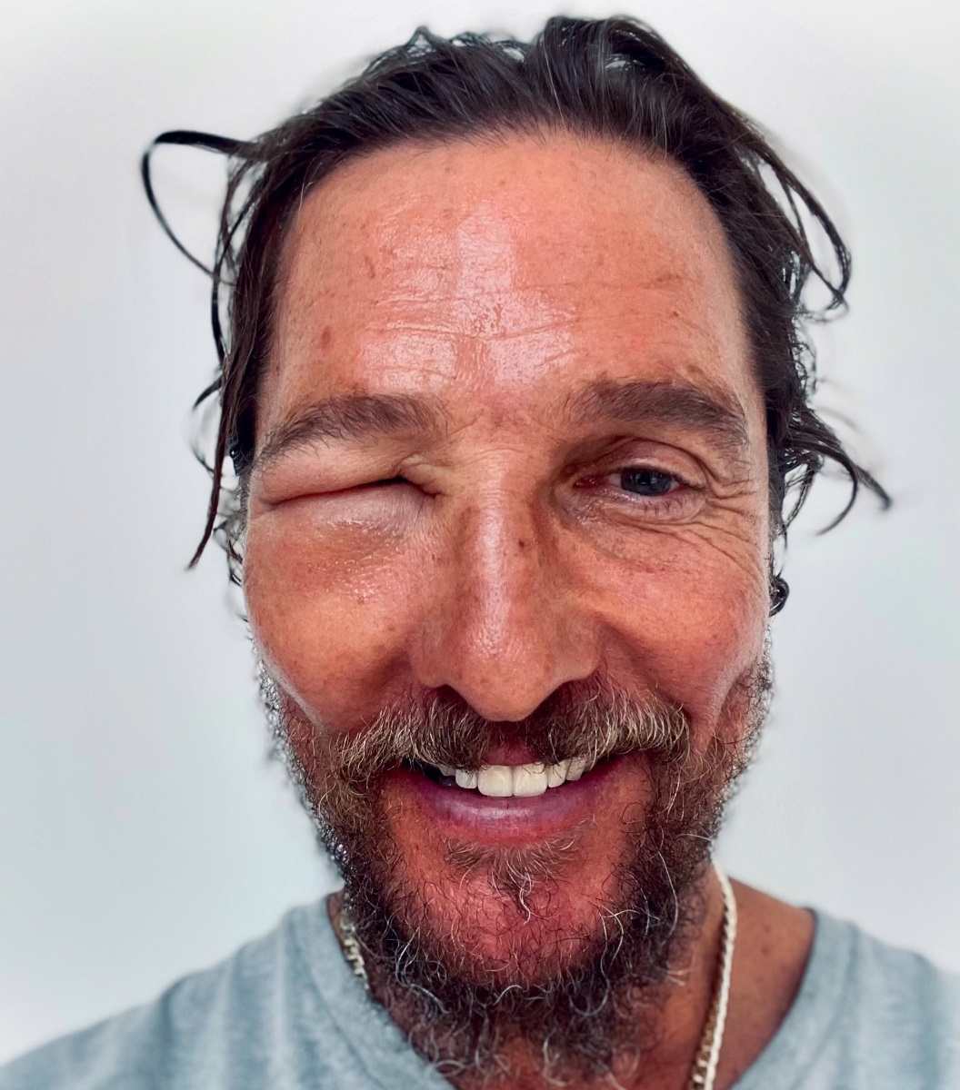 Matthew McConaughey's swollen face1