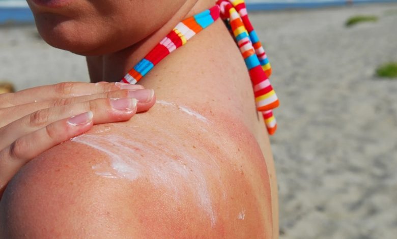 When does sunburn need to see a doctor