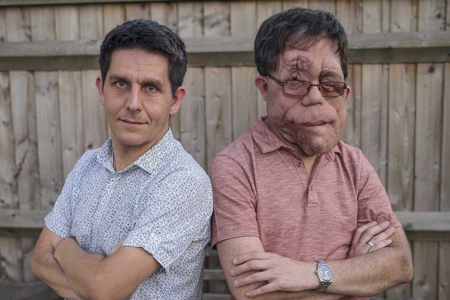 Neil Pearson (left), with his identical twin Adam at home in south London. Twin Adam and Neil have a condition called Neurofibromatosis type 1 which affects them both in different ways.